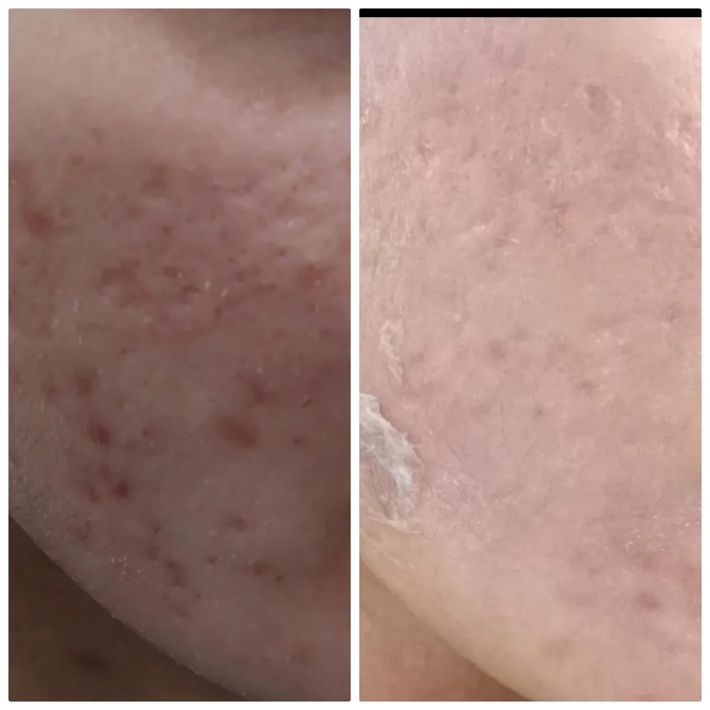 Chemical peel before and after for acne and scarring