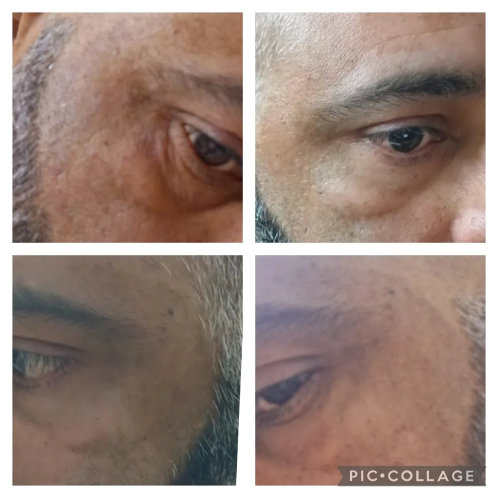 Exosome therapy before and after, under-eye renewal