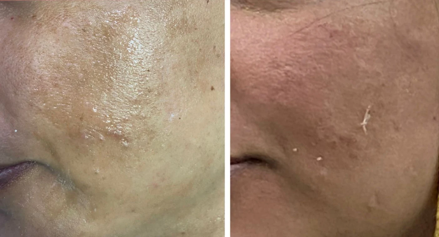 Microneedling before and after, texture and pigmentation