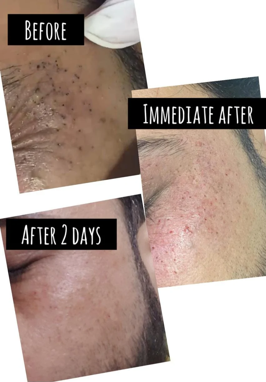 Milia removal by diathermy, before, immediately after and two days later