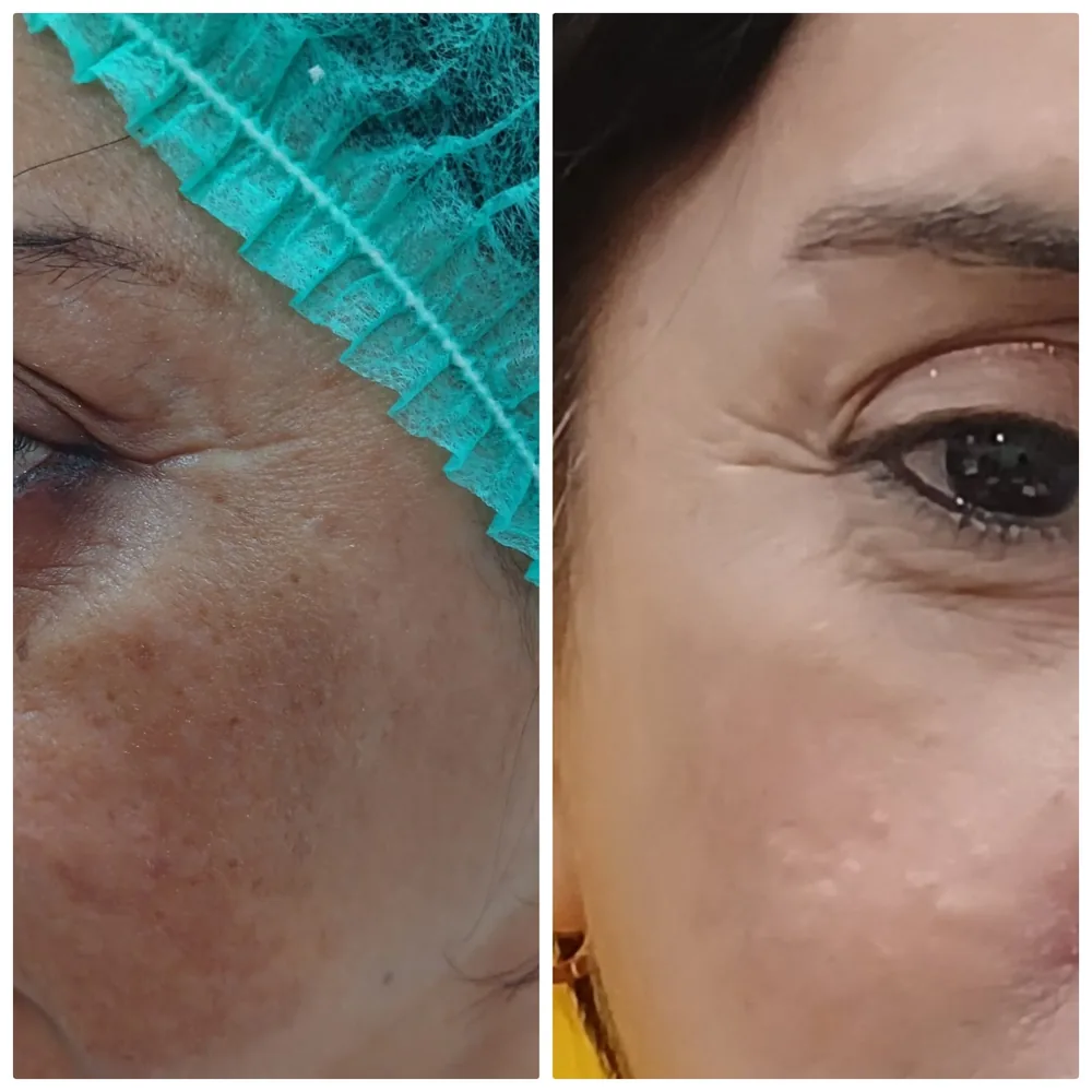 PRP before and after for melasma and pigmentation