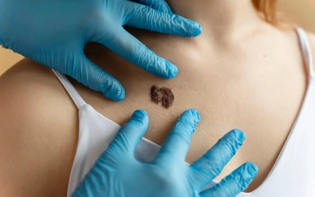Can a Mole Get Infected? 5 Warning Signs Not to Ignore