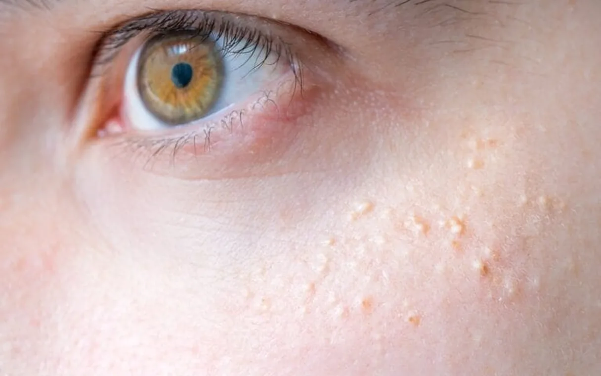 Laser Ablation for Milia Removal in Islamabad