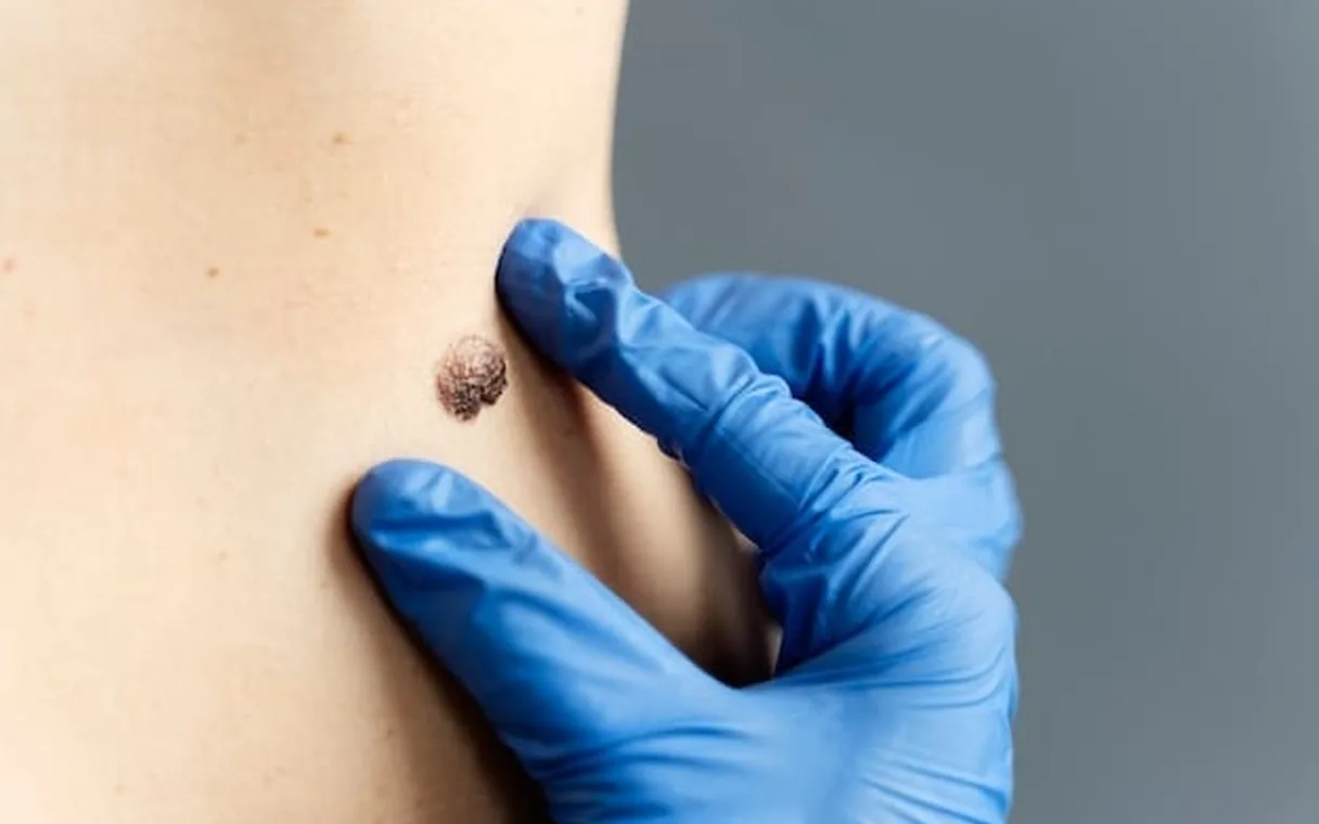 Mole Removal Cost in Pakistan: An Honest Price Guide