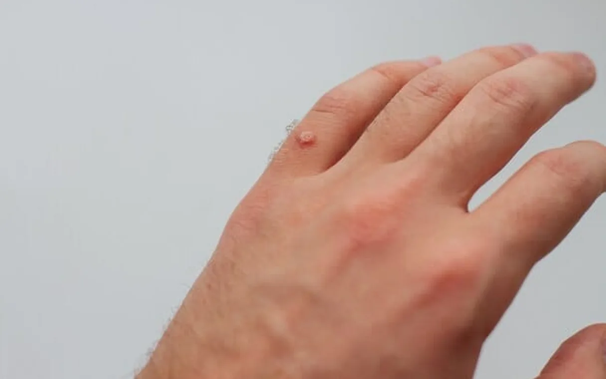Safe, Effective Wart Removal with Laser in Islamabad