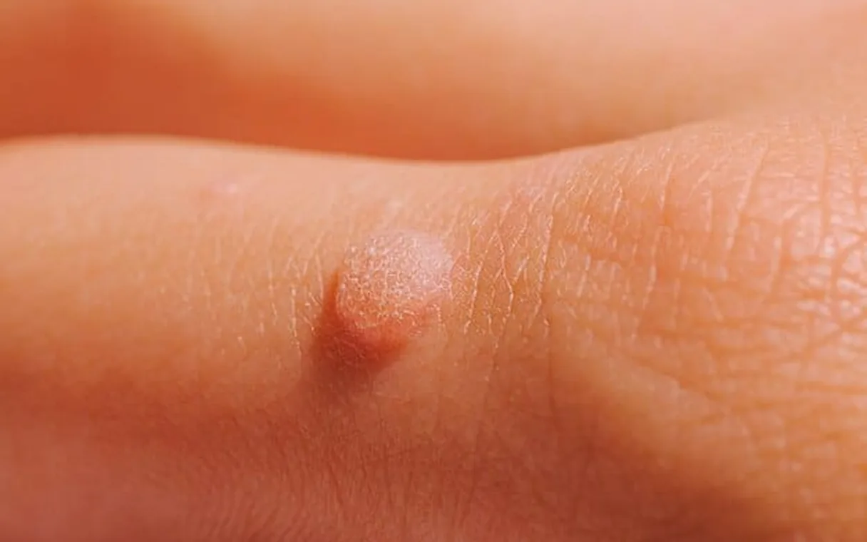 Skin Tag Treatment: Removing Skin Tags on the Face